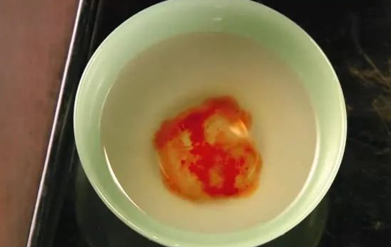 親子鑒定檢驗(yàn)血型血痕,被鑒定人應(yīng)了解自己或近親屬有無遺傳病史
